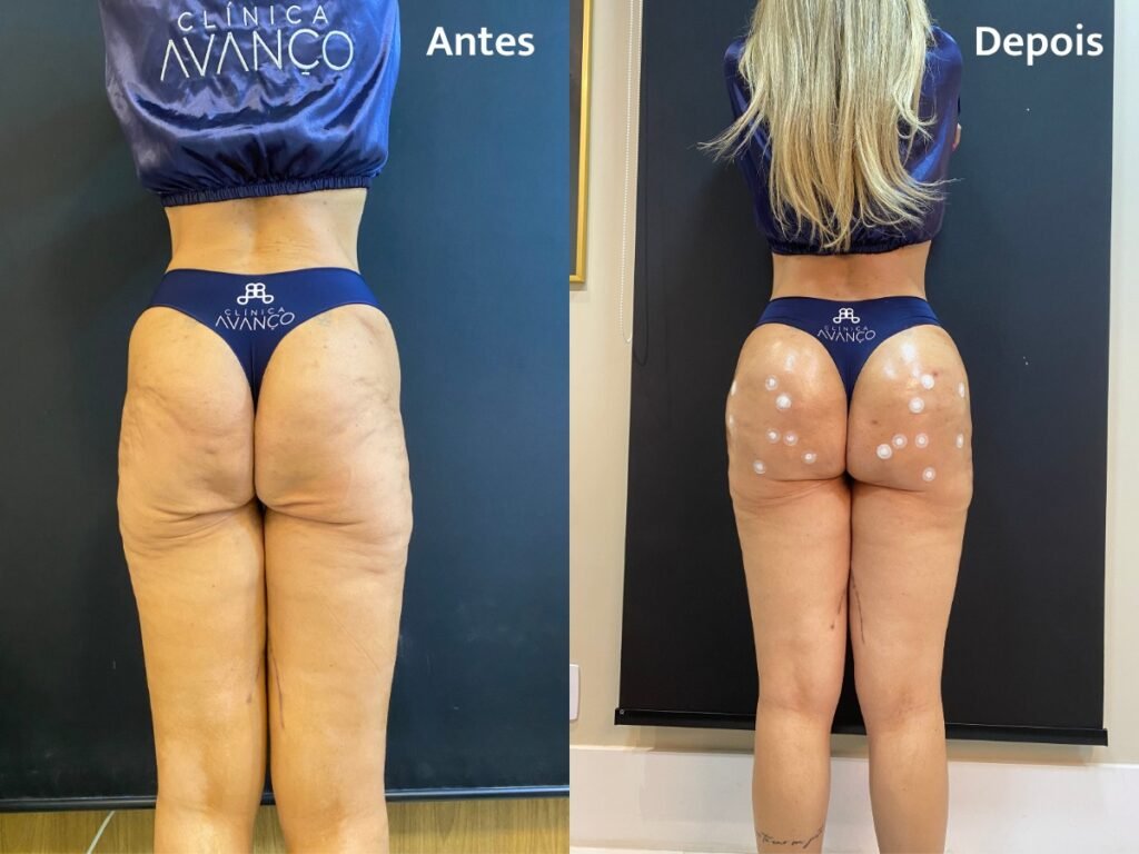 Harmonização glútea corrige flacidez após bariátrica: entenda como funciona