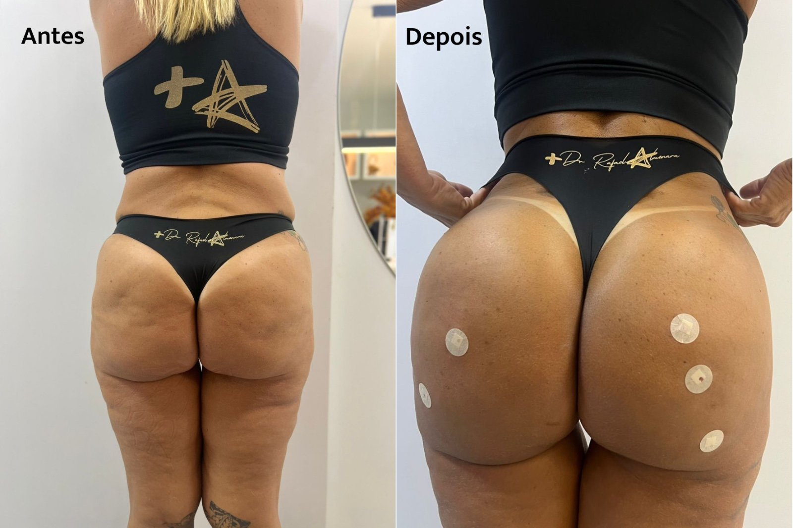 Preenchimento com PMMA corrige volume após emagrecimento