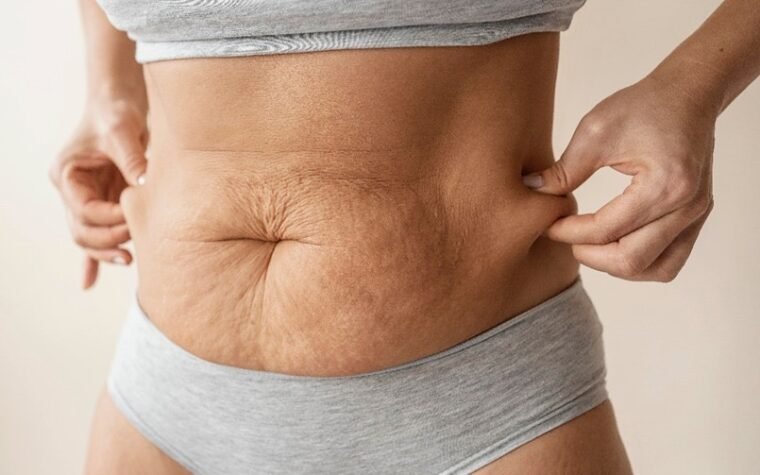 Excesso de pele após emagrecimento: por que acontece e quando a cirurgia deixa de ser estética para virar necessidade