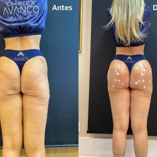 Harmonização glútea corrige flacidez após bariátrica: entenda como funciona