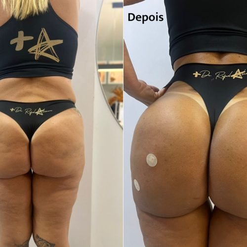 Preenchimento com PMMA corrige volume após emagrecimento